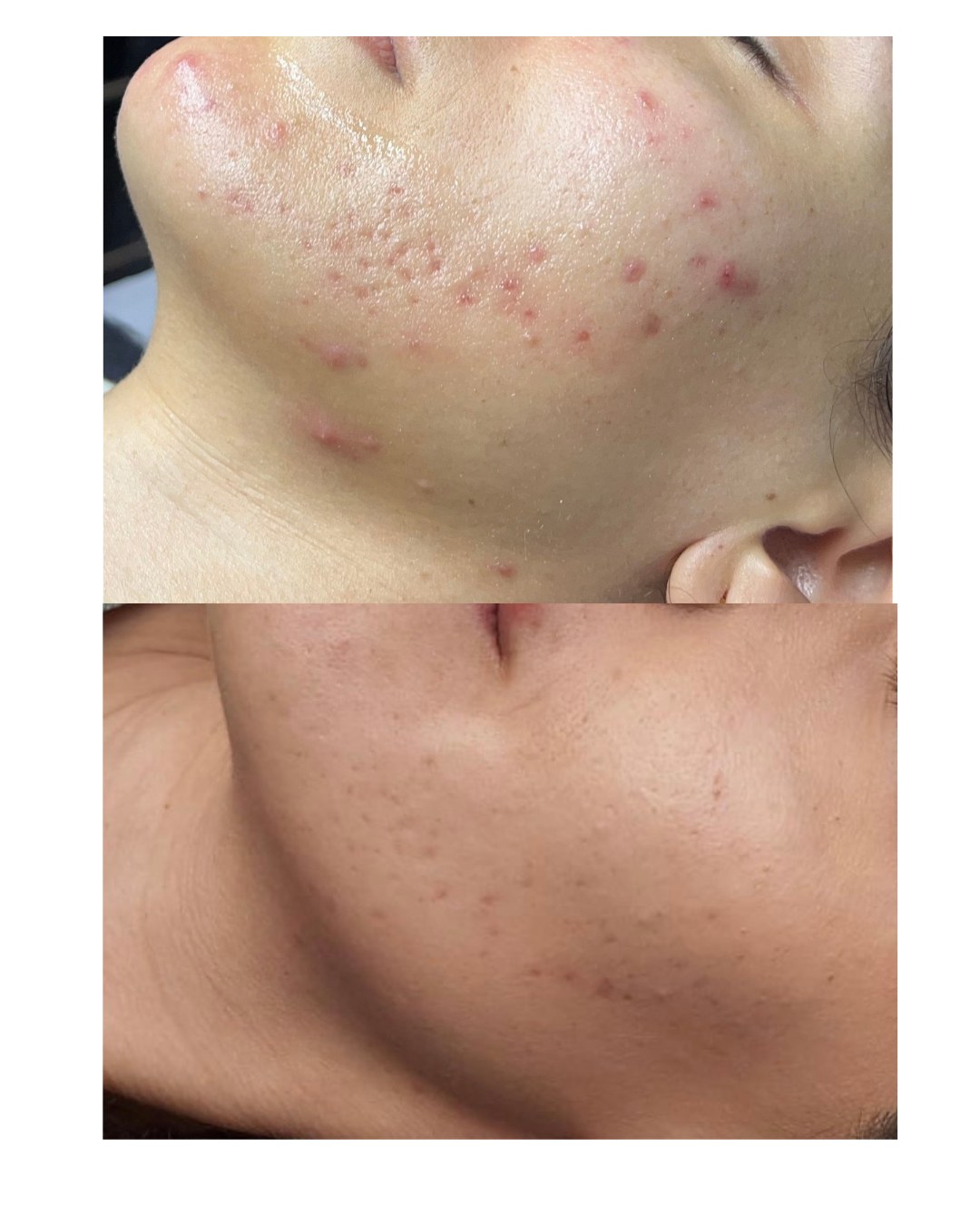 Before and after acne treatment result 3 — The Acne Glow